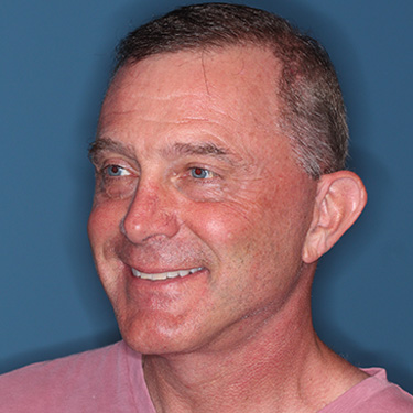 Case--41459 | After Facelift and Neck Lift for Men 3