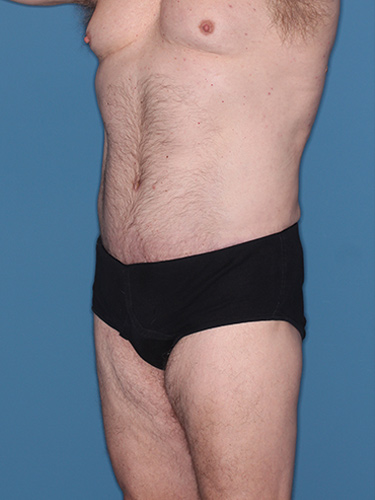 Case--36843 | After True Form Tummy Tuck® for Men 2
