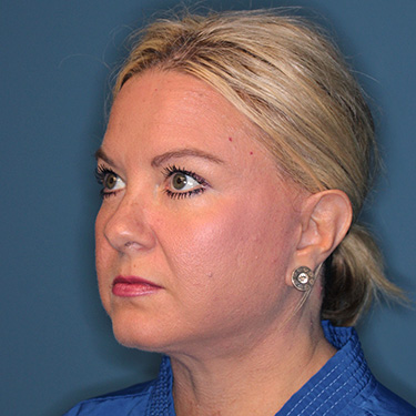 Case--39150 | After Eyelid Surgery (Blepharoplasty) 3