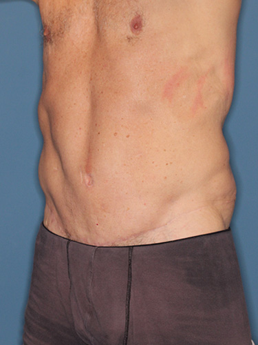 Case--40026 | After True Form Tummy Tuck® for Men 3