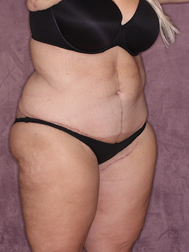 Case--39643 | After Thigh Lift 2