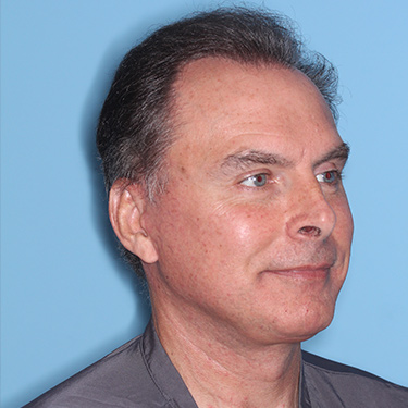 Case--36831 | After Facelift and Neck Lift for Men 2