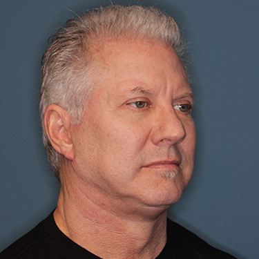 Case--40290 | After Facelift and Neck Lift for Men 2