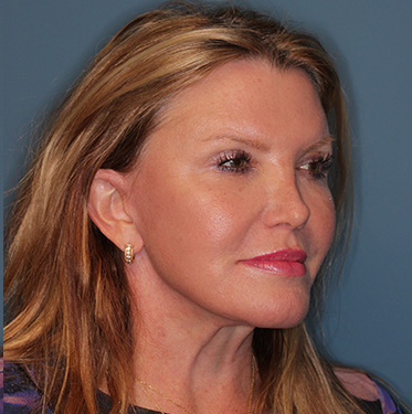 Case--41496 | After Eyelid Surgery (Blepharoplasty) 2
