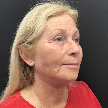 Case--39696 | After Eyelid Surgery (Blepharoplasty) 2