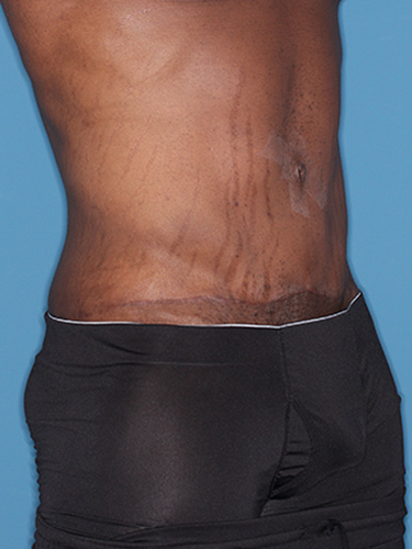 Case--36791 | After True Form Tummy Tuck® for Men 2