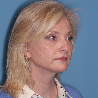 Case--36776 | After Eyelid Surgery (Blepharoplasty) 2