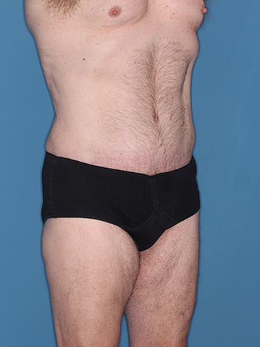 Case--36843 | After True Form Tummy Tuck® for Men 3