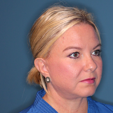 Case--39150 | After Eyelid Surgery (Blepharoplasty) 2