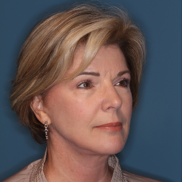 Case--38239 | After Eyelid Surgery (Blepharoplasty) 2