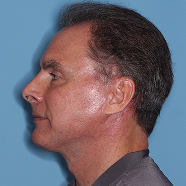 Case--36831 | After Facelift and Neck Lift for Men 5