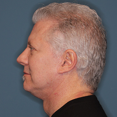 Case--40290 | After Facelift and Neck Lift for Men 5