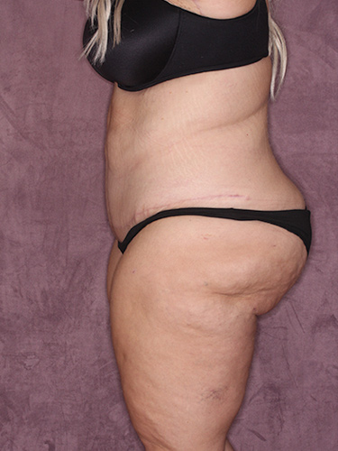 Case--39643 | After Thigh Lift 5