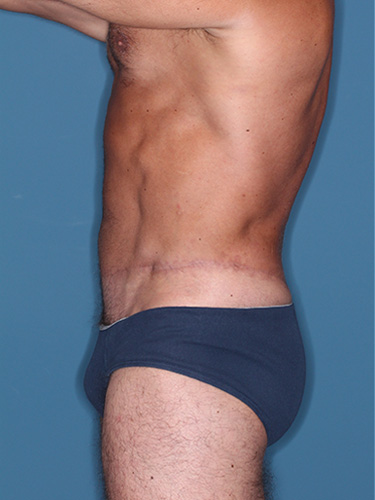 Case--36808 | After True Form Tummy Tuck® for Men 5