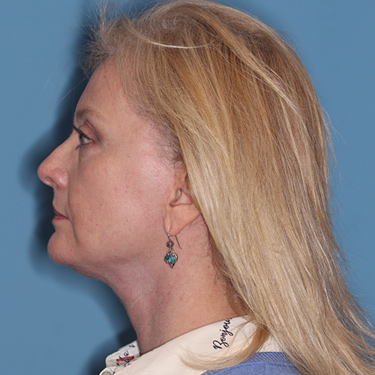 Case--36776 | After Eyelid Surgery (Blepharoplasty) 5