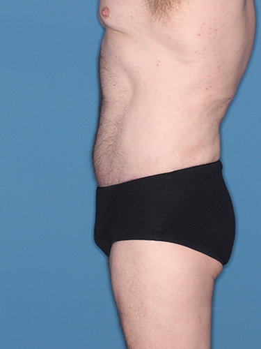 Case--36843 | After True Form Tummy Tuck® for Men 4