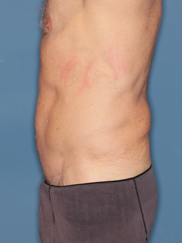 Case--40026 | After True Form Tummy Tuck® for Men 5