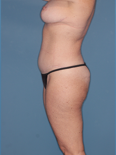 Case--45006 | After Breast Lift with Breast Reduction 5
