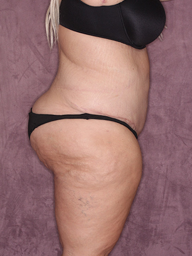 Case--39643 | After Thigh Lift 4