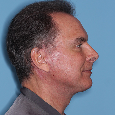 Case--36831 | After Facelift and Neck Lift for Men 4