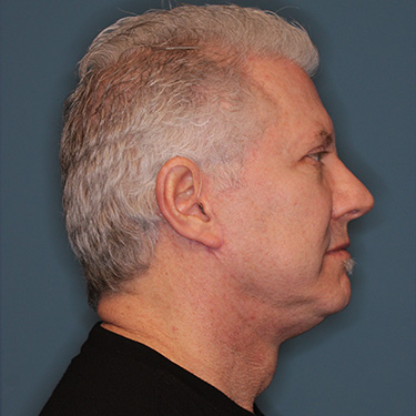 Case--40290 | After Facelift and Neck Lift for Men 4