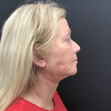 Case--39696 | After Eyelid Surgery (Blepharoplasty) 4