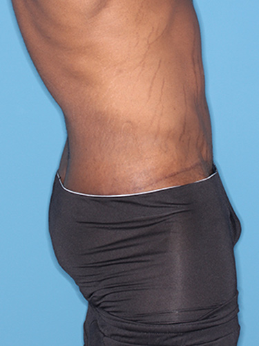 Case--36791 | After True Form Tummy Tuck® for Men 4