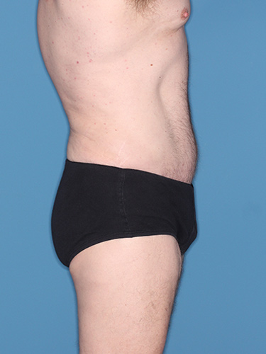 Case--36843 | After True Form Tummy Tuck® for Men 5