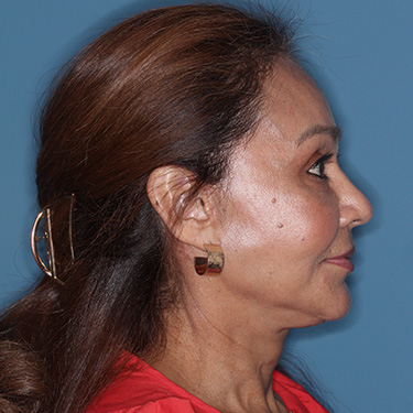 Case--38938 | After Fat Grafting 4