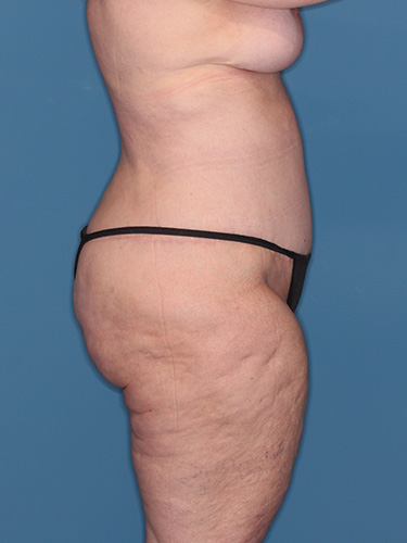 Case--40335 | After True Form Tummy Tuck® in Overweight & Weight Loss Patients 4