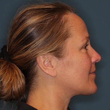 Case--40014 | After Eyelid Surgery (Blepharoplasty) 4