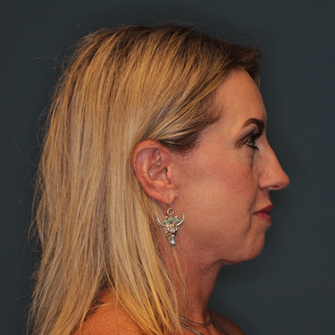 Case--43126 | After Eyelid Surgery (Blepharoplasty) 4