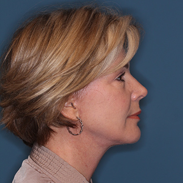 Case--38239 | After Eyelid Surgery (Blepharoplasty) 4