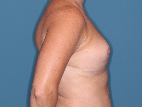 Case--36546 | After Fat Grafting to Breasts 4