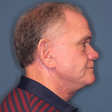 Case--40393 | After Facelift and Neck Lift for Men 4
