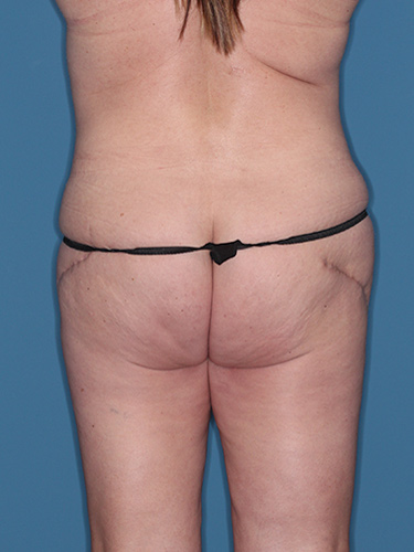 Case--39628 | Before Thigh Lift 6