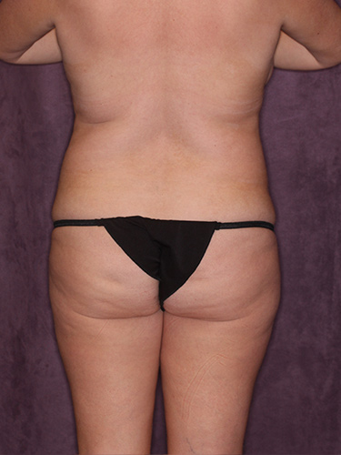Case--36194 | Before Fat Transfer to Buttocks 6