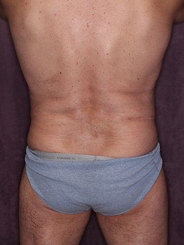 Case--36808 | Before True Form Tummy Tuck® for Men 6