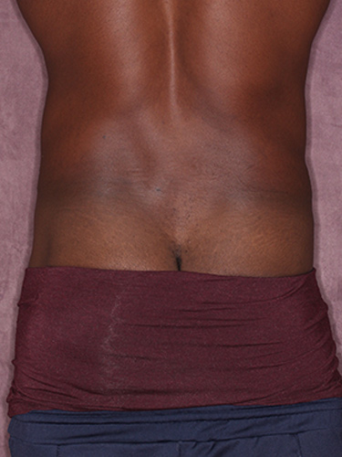 Case--36791 | Before True Form Tummy Tuck® for Men 6