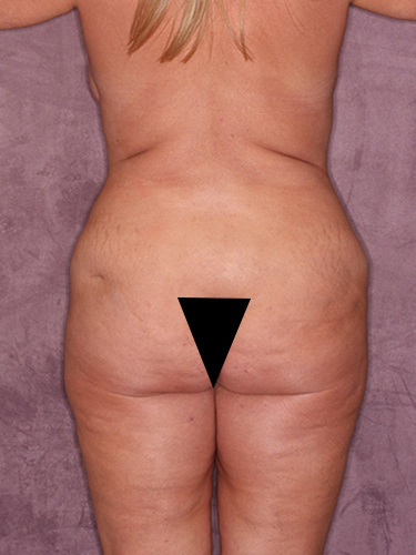 Case--37163 | Before True Form Tummy Tuck® with Lower Body Lift (Buttock Lift) 6