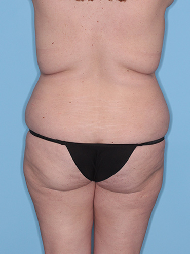 Case--37797 | Before True Form Tummy Tuck® with Lower Body Lift (Buttock Lift) 6