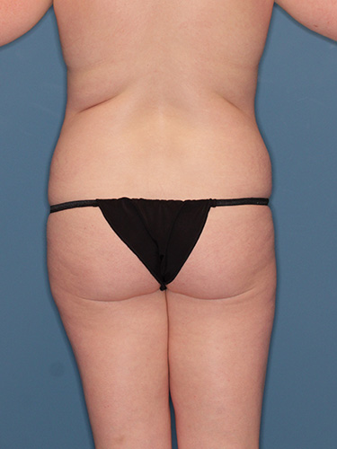 Case--42484 | Before Fat Transfer to Buttocks 5