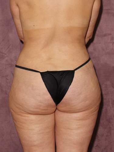 Case--39670 | Before Thigh Lift 6