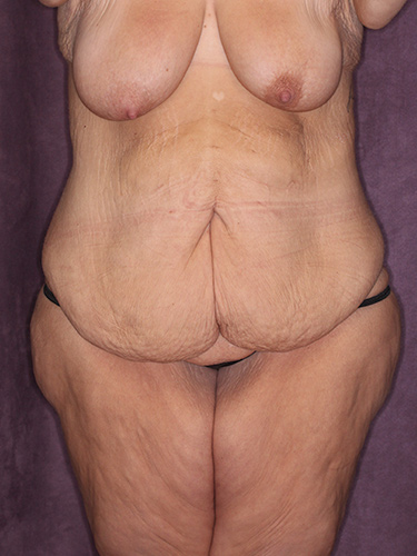 Case--39643 | Before Thigh Lift 1