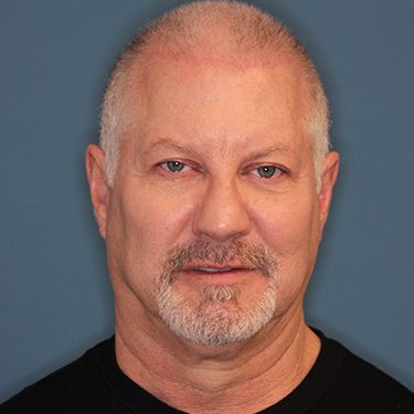 Case--40290 | Before Facelift and Neck Lift for Men 1