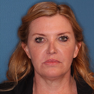 Case--41496 | Before Eyelid Surgery (Blepharoplasty) 1