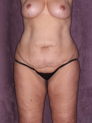 Case--39430 | Before Lower Body Lift (Buttock Lift) 1