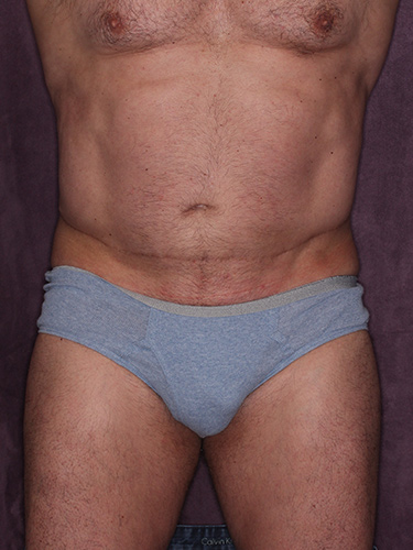 Case--36808 | Before True Form Tummy Tuck® for Men 1