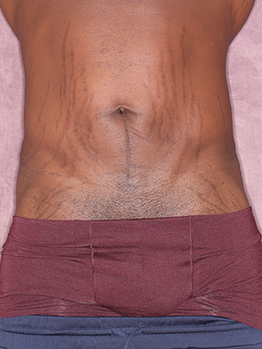 Case--36791 | Before True Form Tummy Tuck® for Men 1