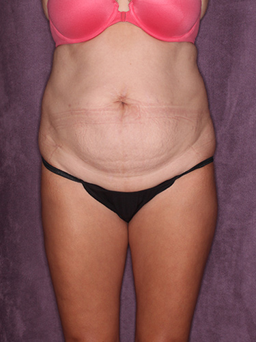 Case--37353 | Before Fat Transfer to Buttocks 1